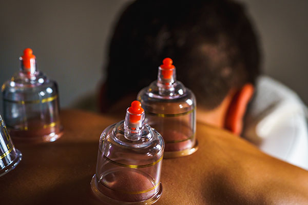 Patient getting cupping treatment on back.