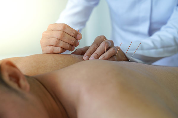 Patient receiving dry needling on the back.
